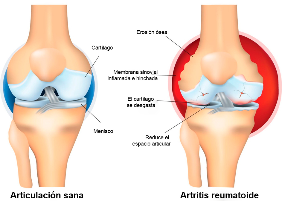 La Osteoartritis: Una Lección de la Clínica Humana para el Profesional de la Veterinaria info artritis